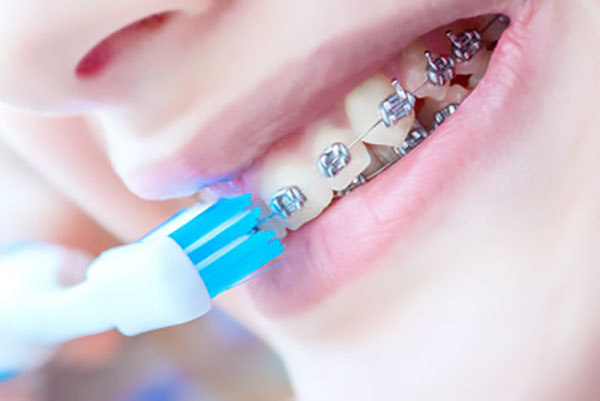 Maintaining Oral Hygiene With Braces